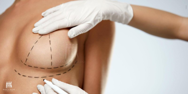 Mastopexia: Conheça a cirurgia para correção dos seios caídos